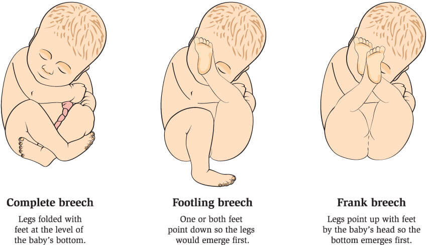 Breech babies in a number of different positions.